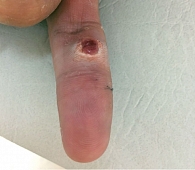 Рис. 7. Больной П., 24 года: пиогенная гранулема (дольчатая гемангиома) – сосудистая гиперплазия