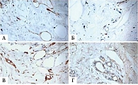 Рис. 4. Иммуногистохимические изменения в ткани опухоли молочной железы после трех циклов ХТ с рекомбинантным ФНО-Т (операционный материал). Окрашивание на CD34 (А), CD31 (Б), EGFR (В), VEGF (Г) (400-кратное увеличение)