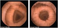 Рис. 4. Изображение различных отделов ободочной кишки при капсульной колоноскопии