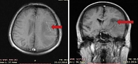 Рис. 1. МРТ головного мозга от декабря 2016 г.: объемное образование левого полушария головного мозга