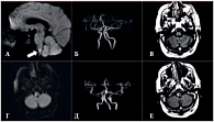 Рис. 6. Данные визуализационного исследования головного мозга пациента Ш., 68 лет: а, г – магнитно-резонансная томография в режиме DWI; б, д – магнитно-резонансная ангиография; в, е – магнитно-резонансная томография в режиме FLAIR