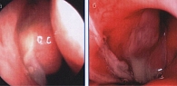 Рис. 2. Эндоскопия носа — гнойные выделения в полости носа и носоглотке