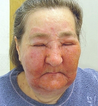 Рисунок 1. Больная С., 61 год, с яркой гиперемией, выраженным отеком, очагами мокнутия и множественными корочками на коже лица
