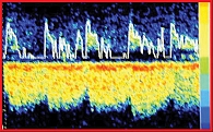 Рис. 2. Увеличение псевдопульсации и интенсивности потока в прямом синусе. Транскраниальная допплерография (субокципитальное окно)