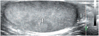 Рис. 10. Эхограмма яичка ребенка 11 лет в норме. 1 – яичко, 2 – головка придатка