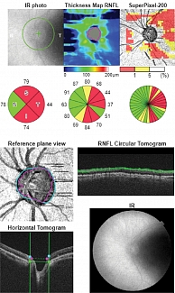 Рис. 1. ОКТ диска зрительного левого глаза: изменение толщины перипапиллярных нервных волокон в нижнем, височном и верхнем квадрантах