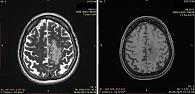 Рис. 9. МРТ головного мозга от июня 2023 г.: прогрессирование не подтверждено