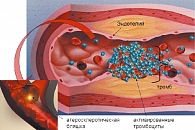 Рисунок 1. Схема формирования тромба и атеросклеротической бляшки в сосуде
