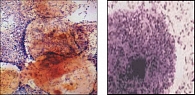 Рисунок 4. Ключевые эпителиальные клетки, покрытые грам-вариабельной коккобацилярной флорой