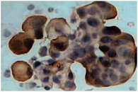 Рис. 5. Иммунопозитивная реакция на эпителиальный антиген (Clone Ber-EP4) при серозном раке яичника. Стрептавидин-биотиновый тест. Окрашивание по Паппенгейму, увеличение в 400 раз