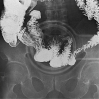 Рис. 2. Рентгенологическое исследование тонкой кишки пациентки Б., 1949 г.р., прицельная рентгенограмма илеоилеоанастомоза