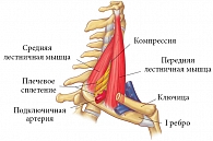 Рис. 2. Топографическая анатомия структур, ответственных за развитие синдрома передней лестничной мышцы