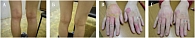 Рис. 1. Проявления аллергических дерматозов: до (А, В) и после (Б, Г) лечения мазью Ирикар