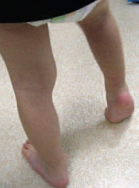 Рис. 2. Пример эквинусной установки стопы у ребенка 3 лет 4 месяцев с диагнозом «ДЦП, правосторонний гемипарез»