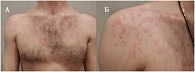 Рисунок. Волдырные высыпания на коже в области груди (А) и плеч (Б) пациента через 5–10 мин после начала провокационного теста (бег на тредмиле)  А