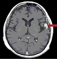 Рис. 2. МРТ головного мозга от марта 2017 г.: церебральный метастаз в коре левого полушария головного мозга размерами 31 × 26 × 15 мм