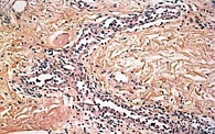Рис. 3. Гистологическая картина при КАПС: периваскулярная нейтрофильная инфильтрация без васкулита, без типичной лимфоцитарной и эозинофильной инфильтрации