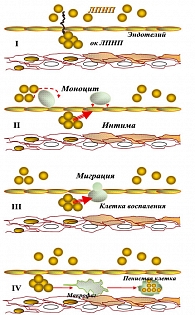 Рисунок 2. Схема этапов формирования атеросклеротической бляшки:  I – окислительная модификация ЛПНП при дислипидемии; II – активация эндотелия (секреция селектина) под действием окисленных ЛПНП  с адгезией клеток воспаления;  III –  миграция клеток воспа