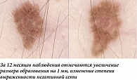 Рис. 15. Меланома кожи, поверхностно-распространяющаяся форма.
