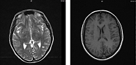 Рис. 3. МРТ головного мозга от 13 августа 2018 г.