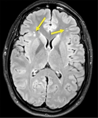 Рис. 2. МРТ головного мозга пациентки