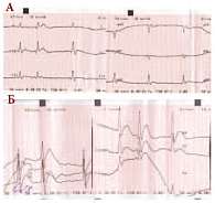 Рис. 2. Резкое укорочение длительности интервала QT (280 мс) после проведения кардиоверсии (А, Б)