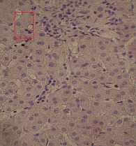 Рис. 9. Внутриклеточный холестаз в отдельных перипортальных гепатоцитах