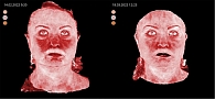 Рис. 4. Данные визиосканирования у пациентки четвертой группы до и после комплексного применения неодимового лазера (1064 нм) и 1%-ного крема ивермектина