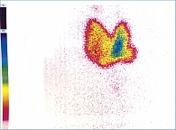 Рис. 2. Сцинтиграмма щитовидной железы пациентки Б.  (1 – «горячий» узел правой доли, 2 – «холодный» узел левой доли)