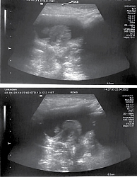 Рис. 2. УЗИ брюшной полости: признаки объемных образований (полипы?) мочевого пузыря