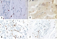 Рис. 5. Лимфоидная инфильтрация в ткани опухоли после трех циклов неоадъювантной ХТ и ФНО-Т (CD3 – немногочисленные лимфоциты (А), CD4 – очаговая лимфоидная инфильтрация (Б),  CD8 – очаговая лимфоцитарная инфильтрация (В), CD20 – немногочисленные лимфоцит