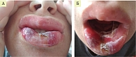 Рис. 3. Прогрессирование клиники мукозита до III–IV степени: А – отек тканей губ, псевдомембранозные поражения; Б – изъязвление и некротизация слизистой оболочки