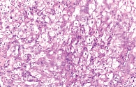 Рис. 3. Гистологический срез опухоли: эозинофильный и вакуолизированный внешний вид клеточной структуры. Кристаллы Рейнке не визуализируются