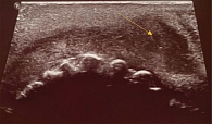 Рис. 4. На УЗИ мягких тканей лица (область губ) в части нижней губы визуализируется гипоэхогенный слой толщиной от 2 до 8 мм с утолщением к левому углу рта