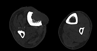 Рис. 3. Рентгенологическая картина деструкции нижней трети большеберцовой кости (сагиттальный срез)