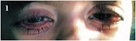 Рис. 1. Внешний вид больного до лечения (видны плотные, сероватые наложения на тарзальной конъюнктиве, выраженный отек и гиперемия век и конъюнктивы, общее раздражение глазных яблок, помутнение в оптической части роговицы справа)