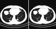 Рисунок. Метастазы в легких (слева) и частичный регресс метастазов после четырех месяцев терапии эрибулином (справа)