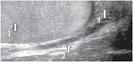 Рис. 12. Эхограмма неизмененного яичка и хвоста придатка. Продольное сканирование. 1 – яичко, 2 – семявыносящий проток, 3 – хвост придатка