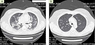 Рис. 1. Компьютерная томограмма легких пациента Б. в динамике от 7 (А) и 14 мая (Б) 2020 г. Картина вирусной пневмонии