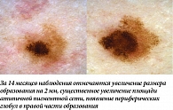 Рис. 18. Меланома кожи, поверхностно-распространяющаяся форма.