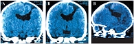 Рис. 4. А, Б, В. РКТ головного мозга больной М., 2 мес., динамика через 1 месяц. На серии компьютерных томограмм толщиной среза 1 мм получены изображения суб- и супратенториальных структур. Порок развития головного мозга. Шизэнцефалия с открытыми краями с