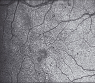Рисунок 2. Непролиферативная диабетическая ретинопатия с начальными изменениями на глазном дне