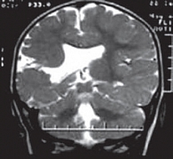 Рис. 1. МРТ головного мозга больного К., 7 мес. Т2 режим, фронтальный срез. Порок развития головного мозга. Сомкнутая правосторонняя шизэнцефалия, соединяющая субарахноидальное пространство и боковой желудочек