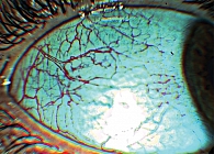 Рис. 4. Биомикроскопия конъюнктивы глаза у беременной с гемоконцентрацией. Неравномерность диаметра и извитость сосудов, сладж-феномен