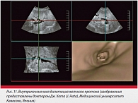 Рис. 11. Внутрипеченочная дилатация желчного протока (изображения предоставлены доктором Дж. Хата (J. Hata), Медицинский университет Кавасаки, Япония)