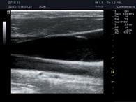 Рис. 3. Продольное сканирование внутренней яремной вены, клапан в устье ВЯВ