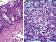 Рис. 2. Больной А. 32 лет: диффузная лимфоплазмоцитарная инфильтрация (А),  формирование крипт-абсцесса (Б). Окраска гематоксилином и эозином (250-кратное увеличение)