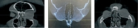 Рис. 1. КТ околоносовых пазух: наличие рентгенопозитивного инородного тела в проекции передней клетки решетчатой кости слева. КТ-признаки девиации перегородки полости носа и ринита