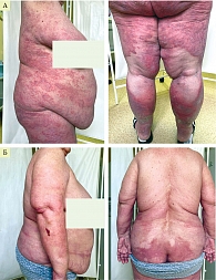 Рис. 1. Пациентка И. до (А) и после терапии гуселькумабом (Б)