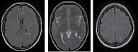 Рис. 2. МРТ головного мозга от 6 апреля 2018 г.